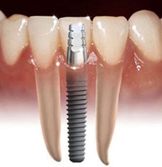 Turkey dental implant