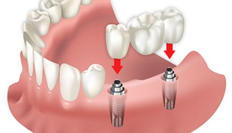 Зубной имплантат в Турции